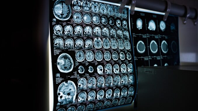 A black screen with blue several MRI pictures of brains